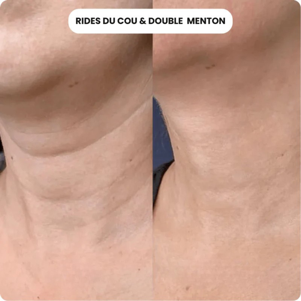 Micro-Infusion Anti-Âge Glov©