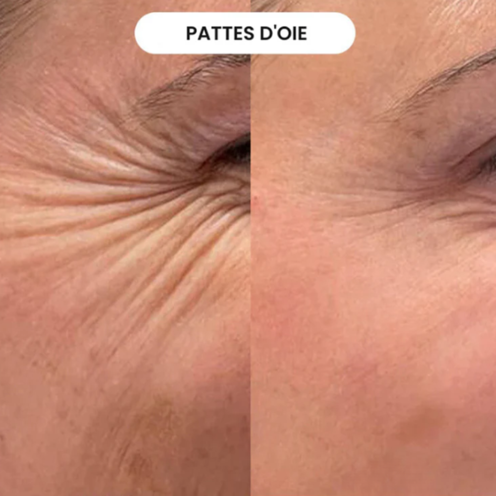 Micro-Infusion Anti-Âge Glov©